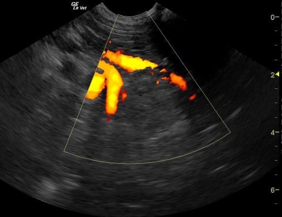 AdrenaladenomawithPowerDoppler