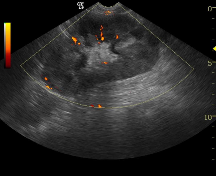 PowwerofRenalLymphoma