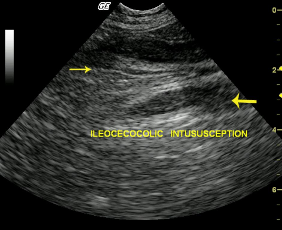 Ileocecocolic intussusception and chronic fibrosing enteritis in a 16 ...