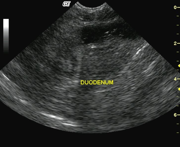 DIlatedDuodenumfromObstruction