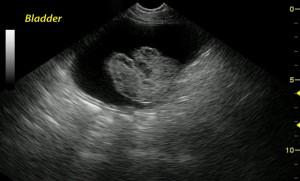 Bladder TCC and is it resectable? What is your criteria?