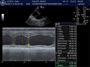 Is It DCM or MR + Myocardial insufficiency?