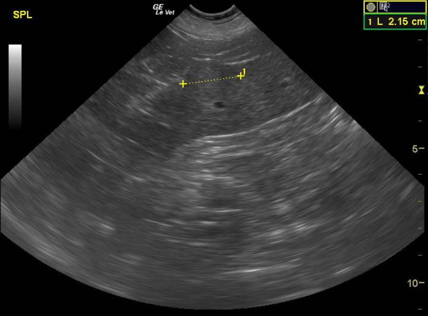 SpleenShermanGunnnosigsplenichematoma2_08262012050859