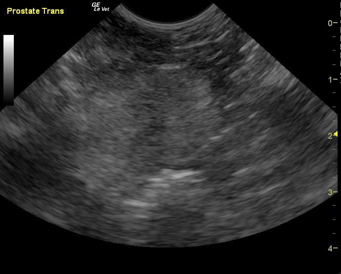 Benign prostatic hyperplasia and an inguinal testis (unilateral ...