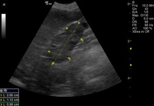 LDDST and stress with ultrasound- treat or not to treat Cushings and when