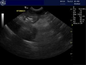 Hyperbilirubinemia and small liver