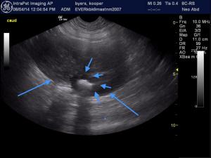 LN vs Intestinal Mass