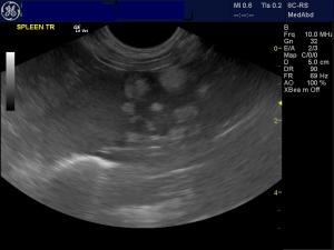 Rising ALT and elevated post bile acids (40) in an asymptomatic patientR/
