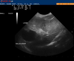 Polypoid Hyperplasia of the Gallbladder Neck