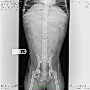 Splenic Mass