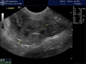 Renal failure in a 2 year old mn DSH