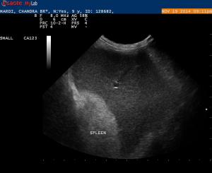 Abnormal Left Kidney & Spleen