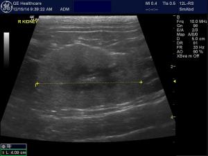 Renal mineralization vs. renolithiasis
