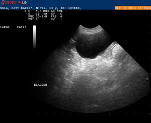 Bladder Mass