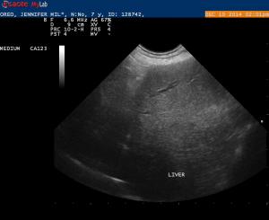 Post Hepatic Obstruction