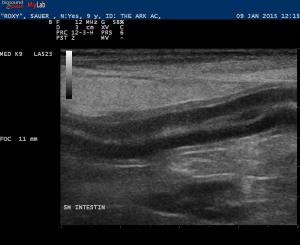 Protien losing enteropathy
