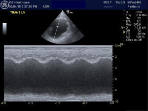 Doberman with advanced occult DCM