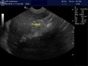 Echogenic stomach lining