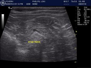 Gastritis