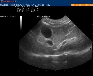 Geriatric Cystic Duct/CBC