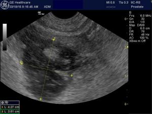 Liver Lesion-Differentials and Next Step