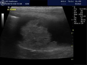 Criteria for bladder mass resection