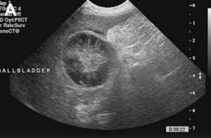 Biliary Mucocele