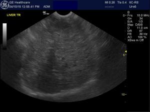 Abnormal gallbladder, liver, and abdominal effusion