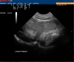 Hepatic Mass