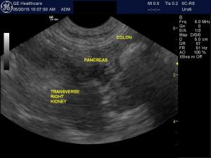 Rebound hyperglycemia in presumed insulinoma dog
