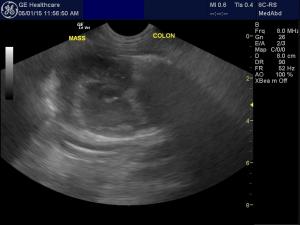 Mass emerging from colon wall-what does this?