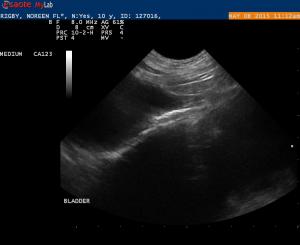 Prostatic Cyst