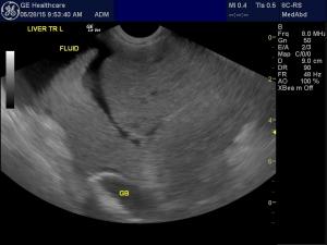 Ok to biopsy if platelets are decreased?