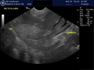 Progressive hepatic and gallbladder changes