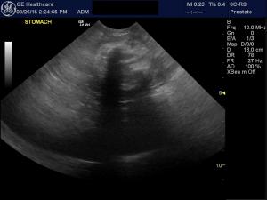 Gastric foreign body