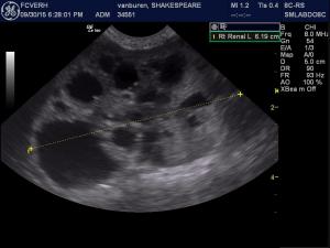 polycystic kidneys?