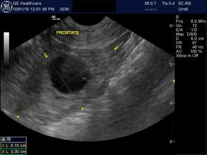 Cystic prostatomegaly and lympadenopathy in a 7 year old male neutered lab