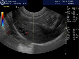 Cystic lesions in a feline liver