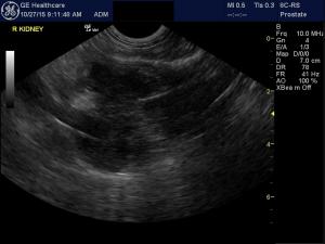 Pancreatitis, pancreatic neoplaisa, or mesenteric root neoplasia