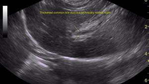 Imaging the common bile duct to the duodenal papilla