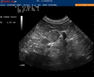 Adrenal Nodules, calcification and hyperechoic pancreas - Members