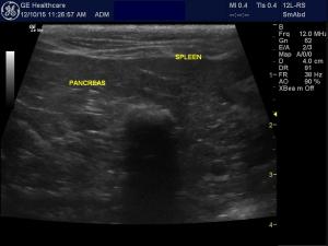 Mineralization in the left pancreas