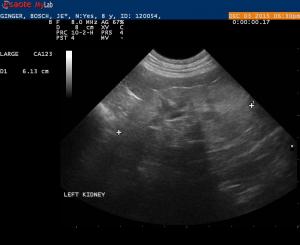 Stage 2 Chronic Kidney Disease