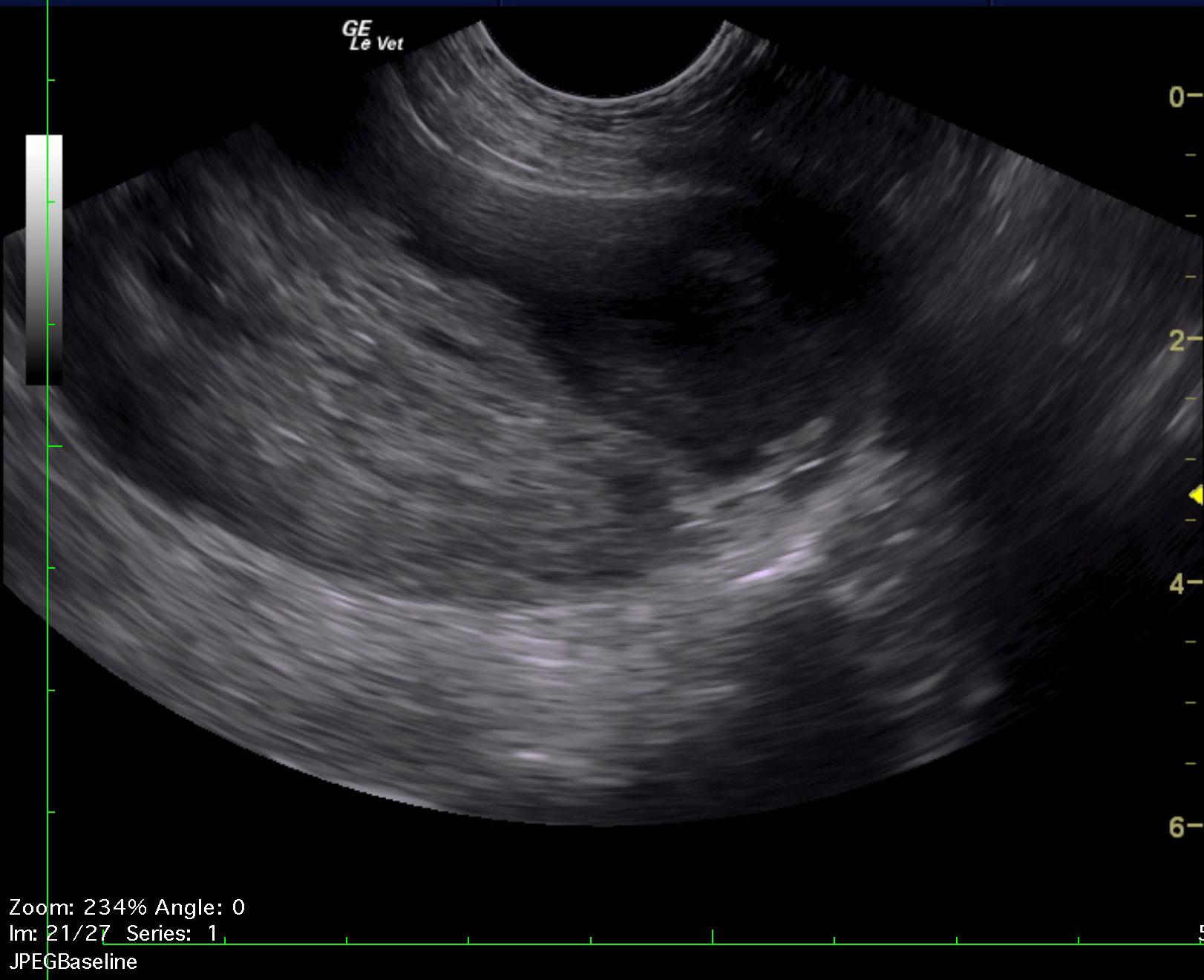 napoleon_rathgeber_prostatic_abscess_2