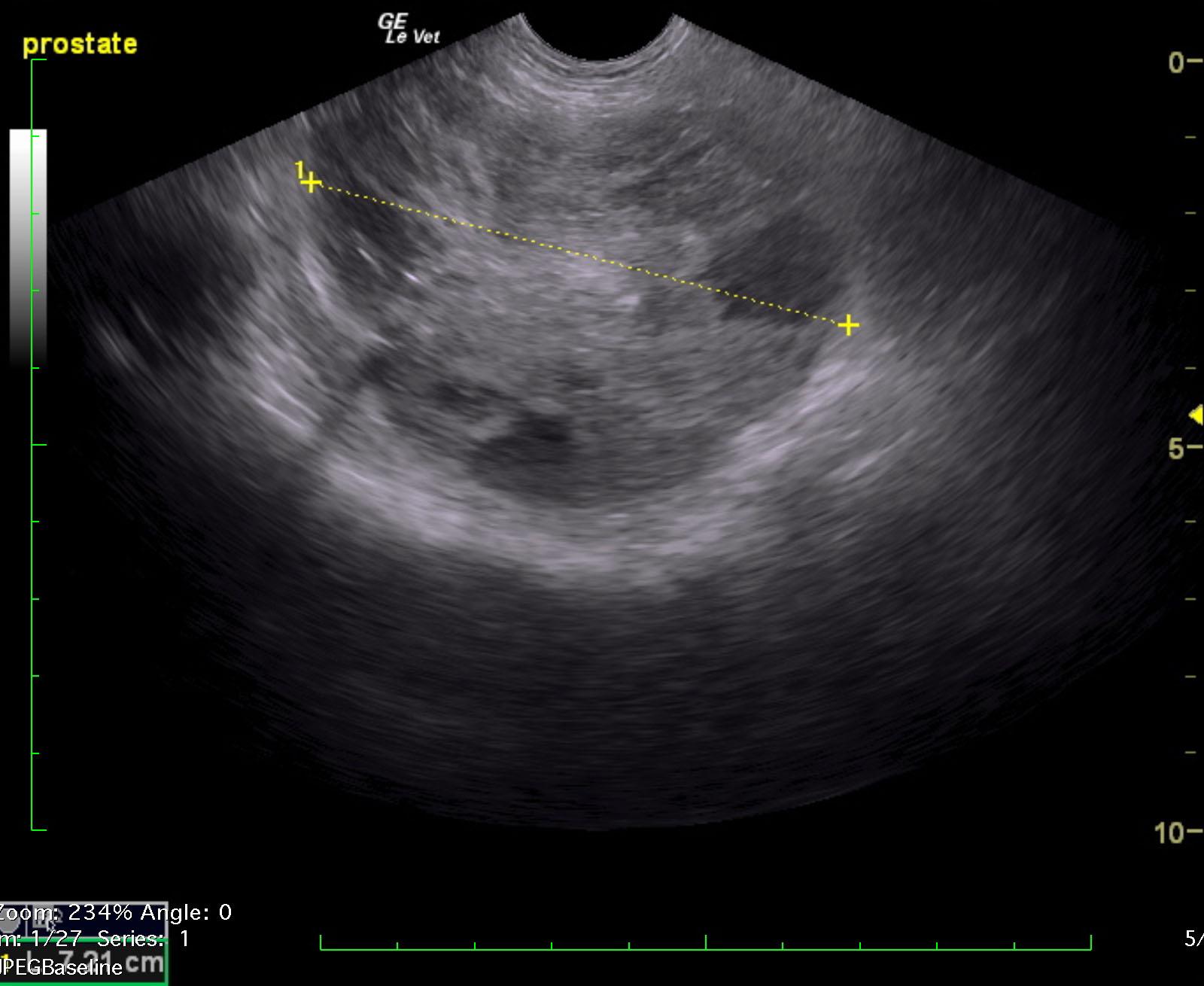 napoleon_rathgeber_prostatic_abscess_splenic_thrombus