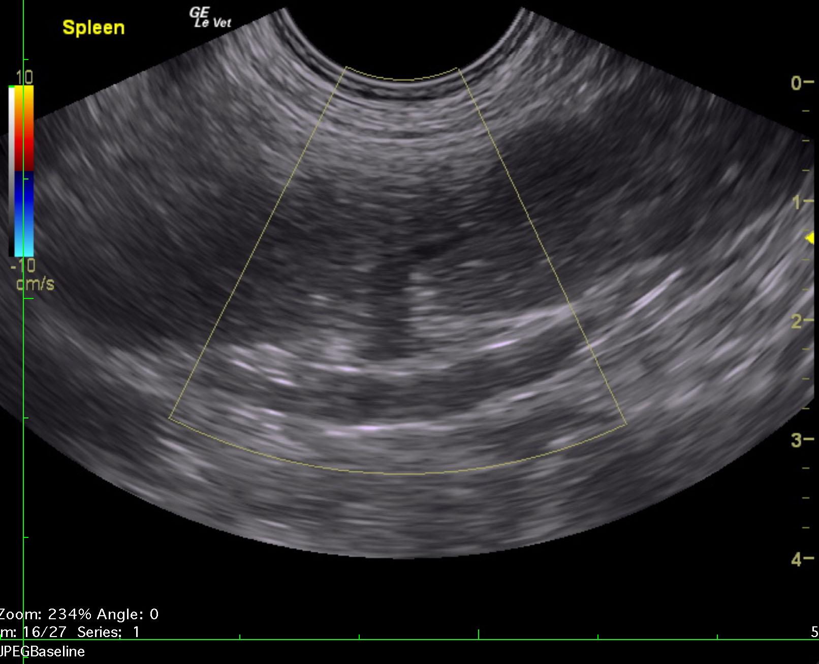napoleon_rathgeber_prostatic_abscess_splenic_thrombus_1