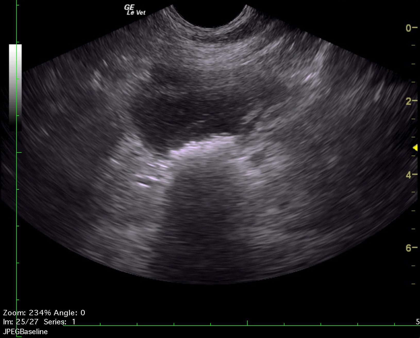 napoleon_rathgeber_prostatic_abscess_splenic_thrombus_ub_sand