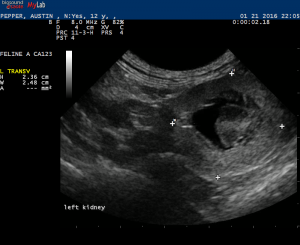 Prominent Duodenal Papilla