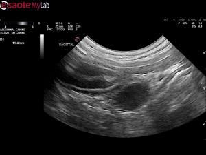 Pancreatic/duodenal wall cyst in an 11 year old FS Shihtzu
