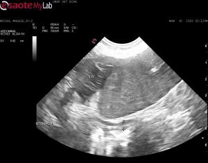 Splenic torsion? Thrombosis?